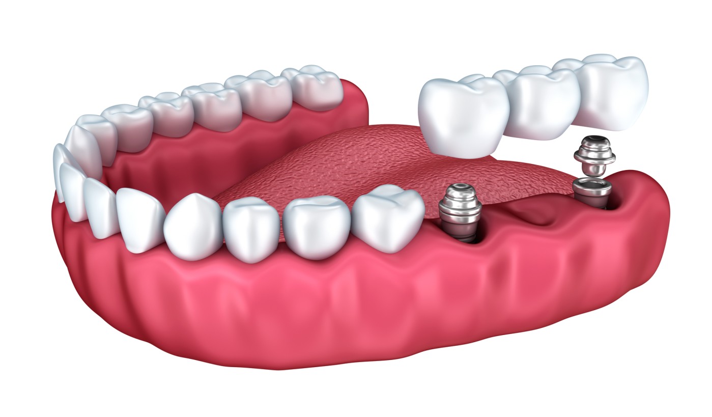 Crowns Bridges Treatment in Ipswich