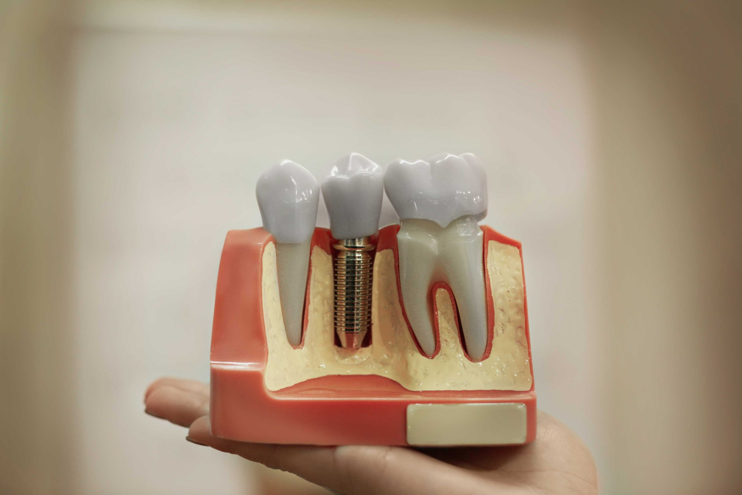 Implant Based Restorations