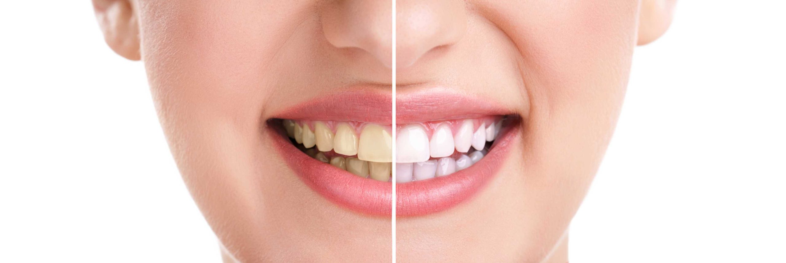 Teeth Whitening Treatment in Ipswich